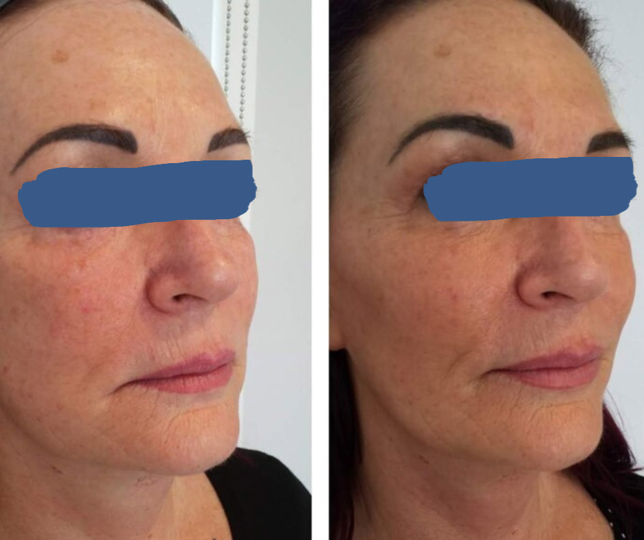 Cheek Fillers To Restore Curvature To The Mid Face Freya Aesthetics