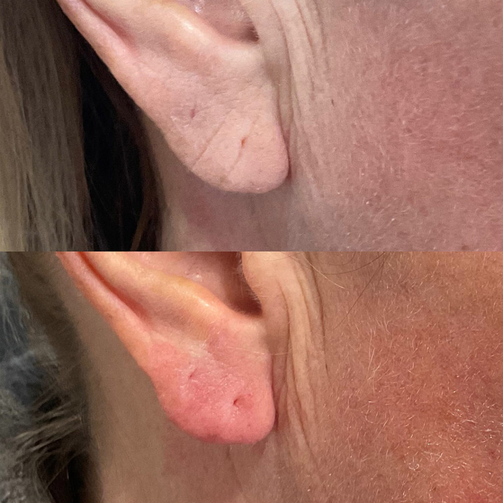 Freya Aesthetics Fine Lines Filler Rotorua