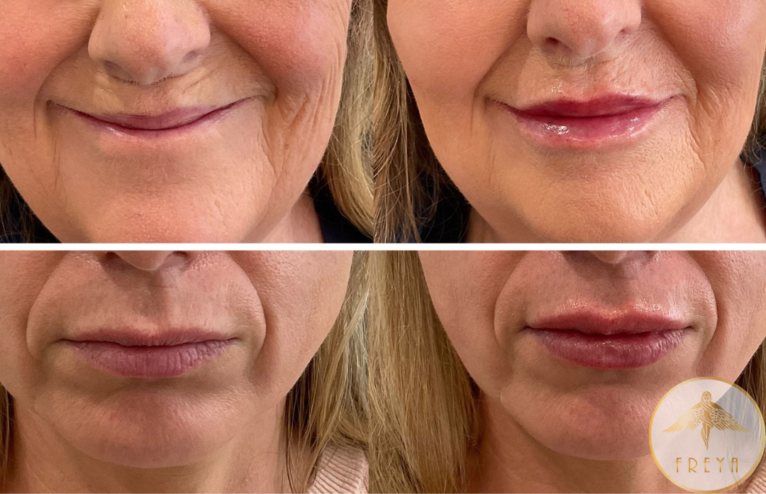 Freya Aesthetics Lip Filler Rotorua Bay Of Plenty Dermal Filler Treatments