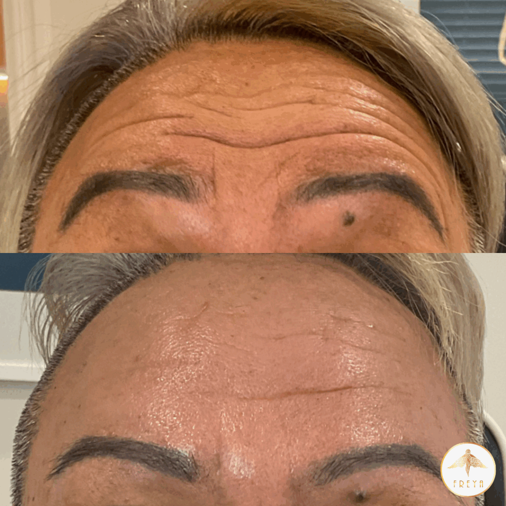 Anti-wrinkle injections forehead Freya Aesthetics