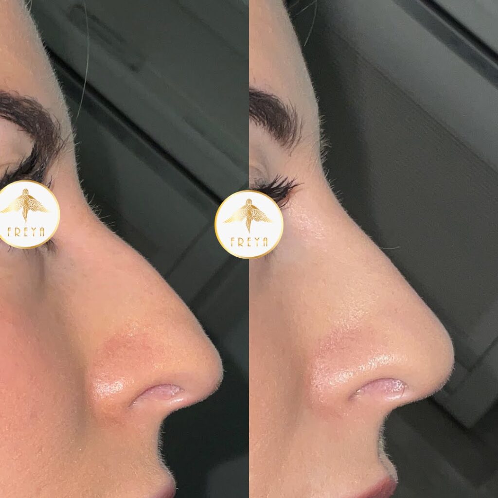 Liquid Rhinoplasty Freya Aesthetics